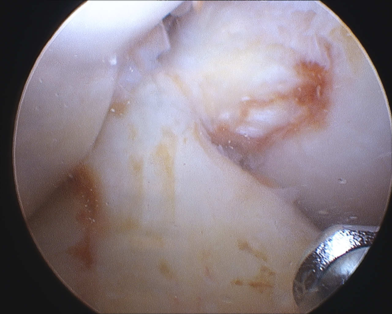 ACL post PVNS Debridement